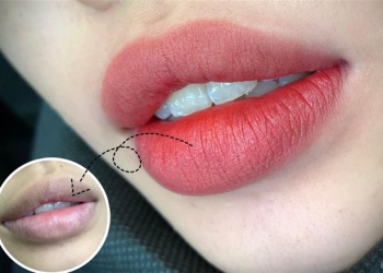 Dịch vụ Khử thâm môi